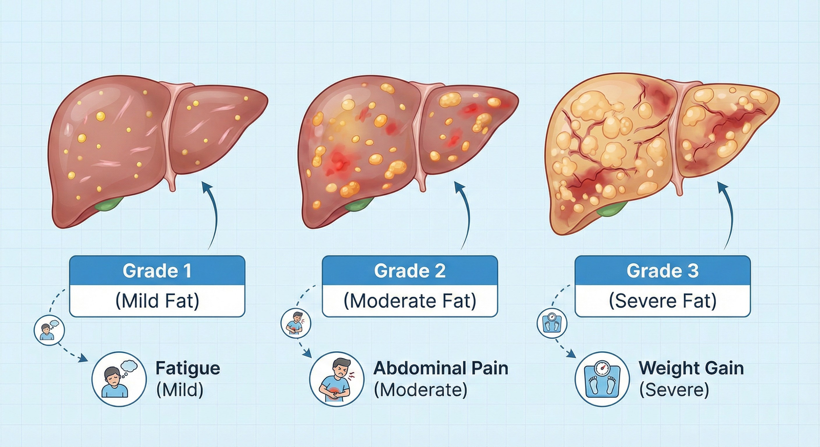 Diagram of fatty liver disease showing Grades 1, 2, and 3 with fat accumulation and related symptoms.