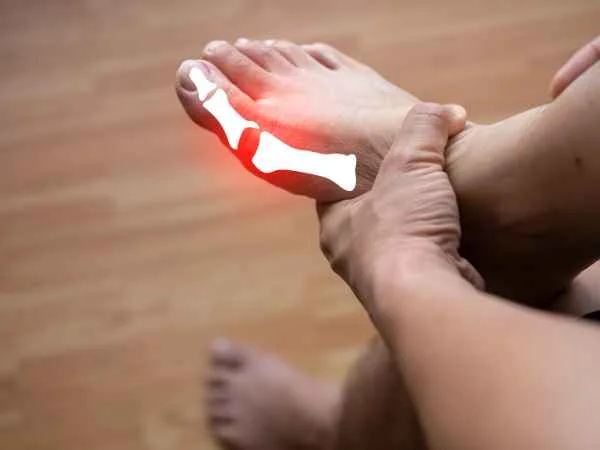 Causes and Risk Factors of Increased Uric Acid Levels