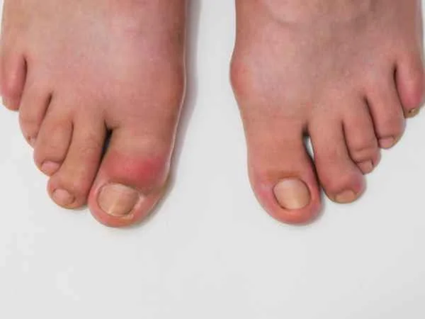 Symptoms of High Uric Acid