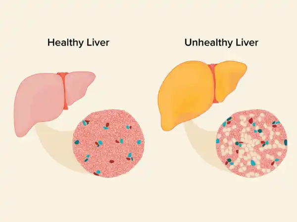 Essential Facts for You about Fatty Liver Disease