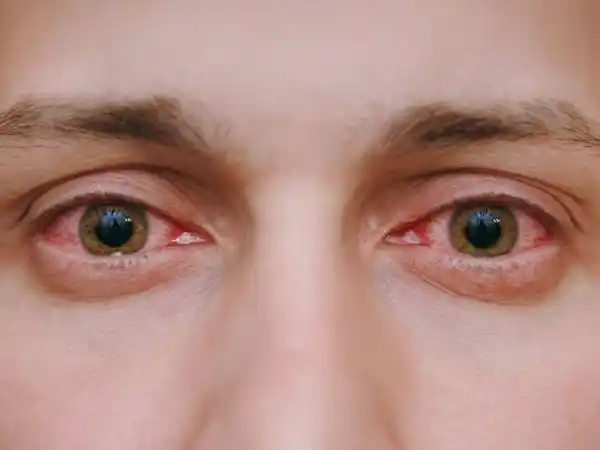 Red Eyes Explained Symptoms, Causes, and Remedies