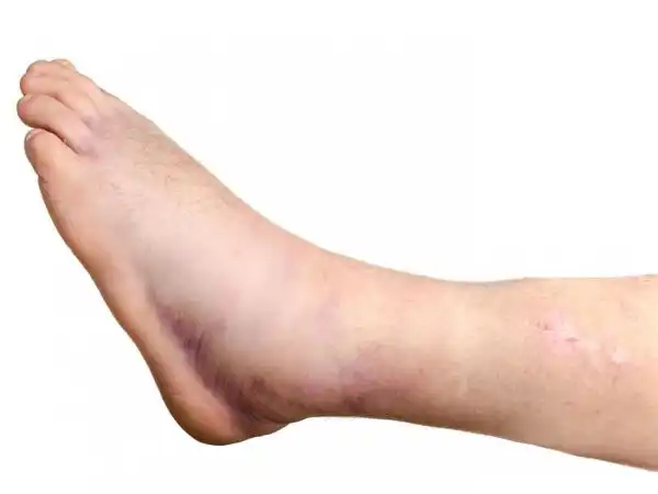 Swellings of the Legs, Ankles, or Feet