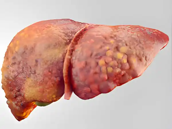 Fatty Liver Solutions