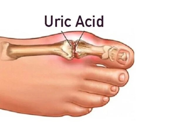 Understanding Uric Acid and Its Impact on Health
