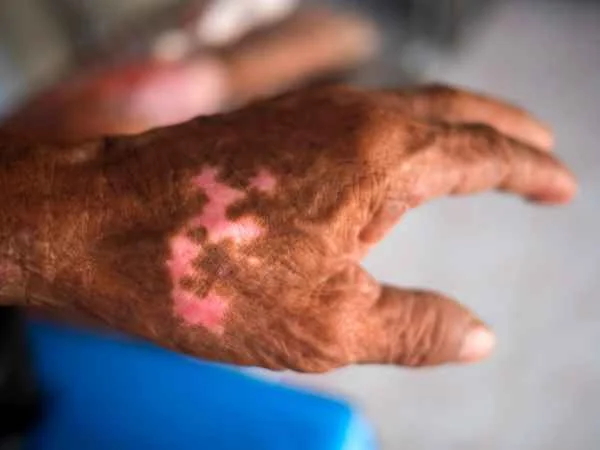 The Stigma Effects Among Persons with Leprosy