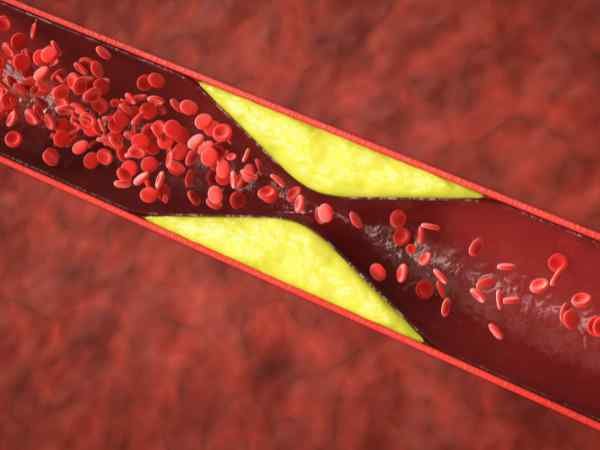 5 Warning Signs of High Cholesterol on Your Face and Eyes