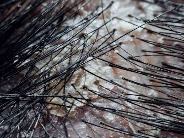 Controls Dandruff and Scalp Infections