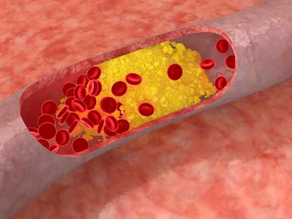 Do-It-Yourself Home Tests for Cholesterol Symptoms