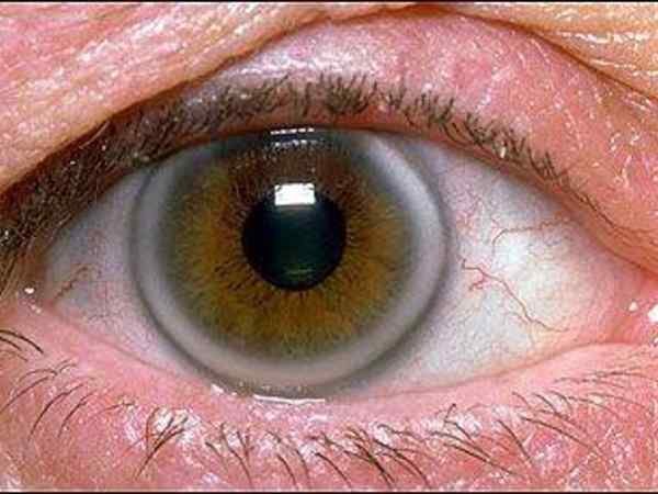 Gray or White Ring Around the Cornea (Arcus Senilis)