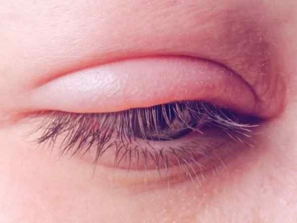 Swollen or Puffy Eyelids