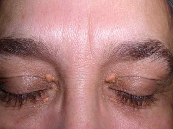Yellowish Bumps on Eyelids (Xanthelasma)