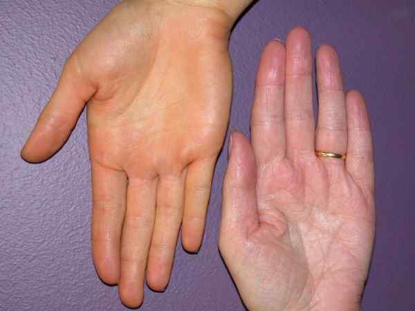 Yellowish Color of the Skin (Carotenemia-like Appearance)