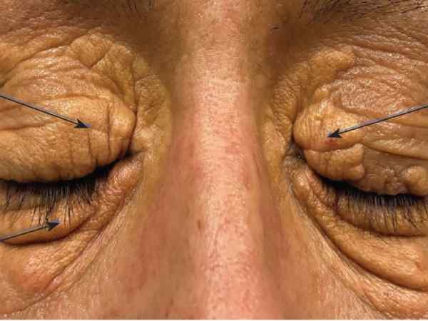 Yellowish Patches on Skin (Xanthomas)