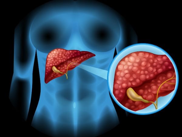 Chronic Liver Parenchymal Diseaseof Conservation of Glacier
