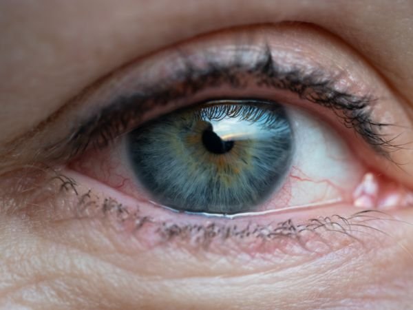 Normal-Tension Glaucoma (NTG)