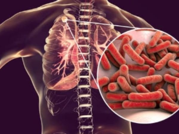 Psychological Harm Created by Tuberculosis
