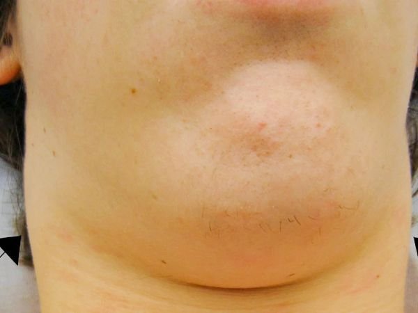 Swollen Lymph Nodes in Your Neck