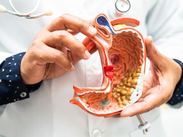 Symptoms of Stomach Cancer