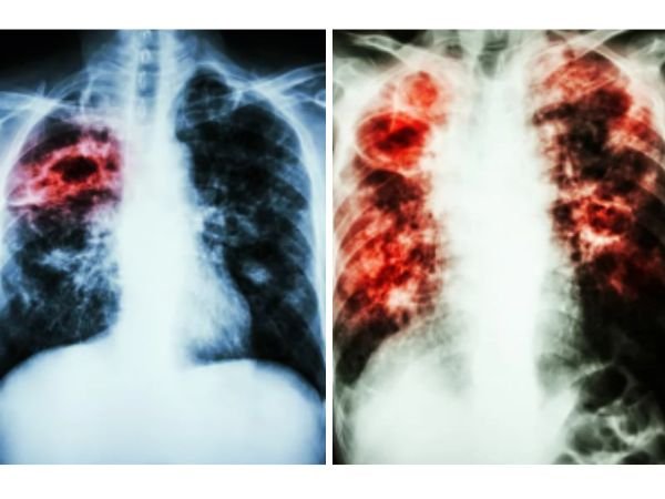 Understanding Tuberculosis and Its Psychological Burden