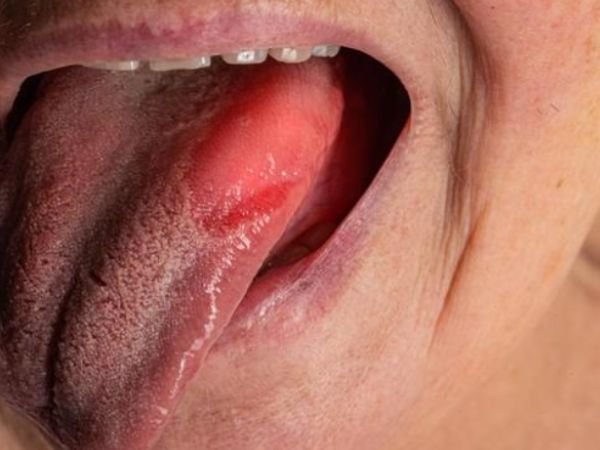 Cracks, Spots, and Other Conditions of the Tongue