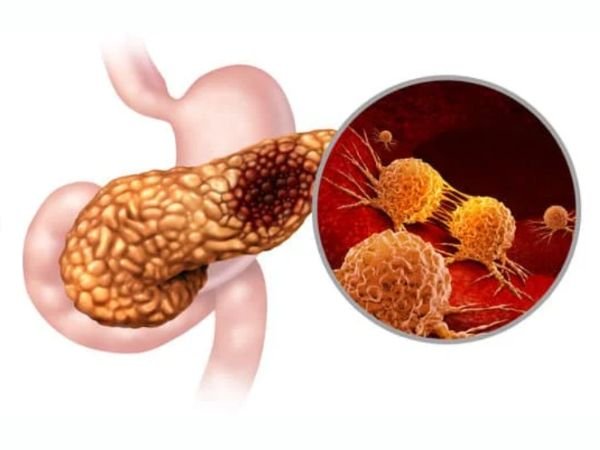 Esophageal Cancer_ Causes, Symptoms, and What You Should Know!