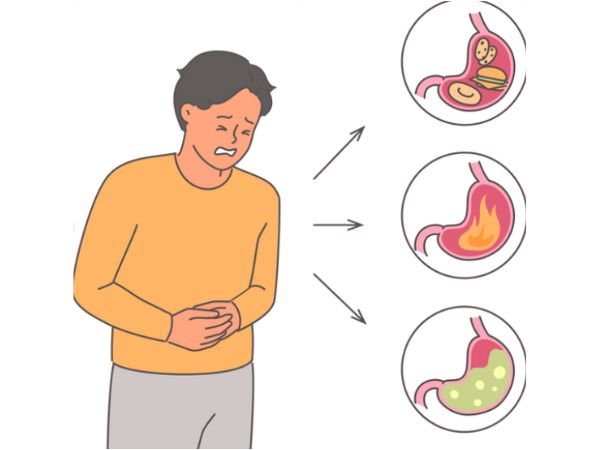 What Causes GERD?