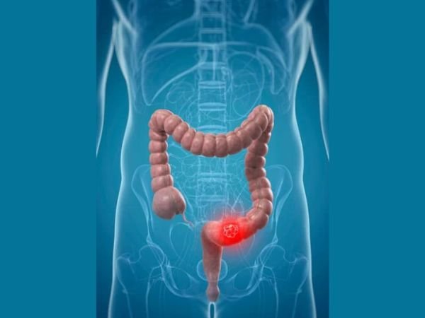 What is Esophageal Cancer