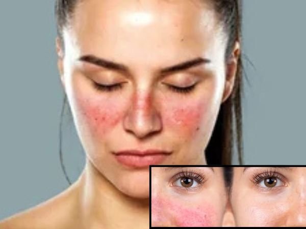 Butterfly-Shaped Rash on Face and Nose (Malar Rash)