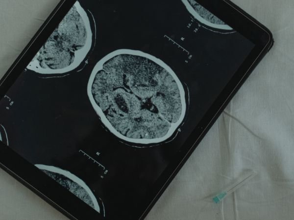 What Is Brain Death