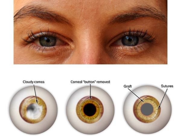 What is Corneal Transplant Surgery (2)