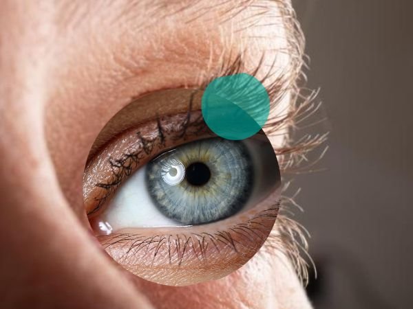 What is Corneal Transplant Surgery