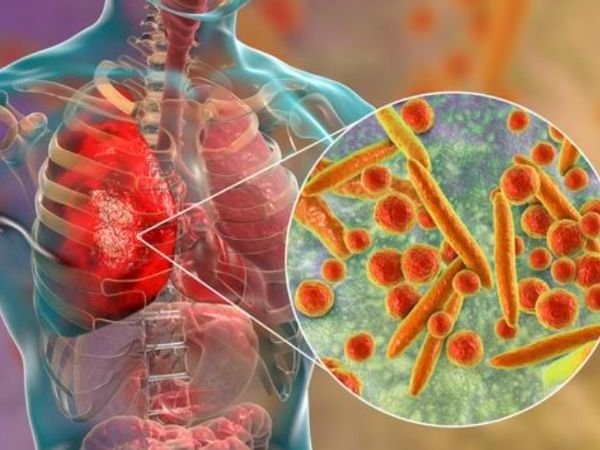 Causes of Pneumonia_ Bacteria, Viruses, and More