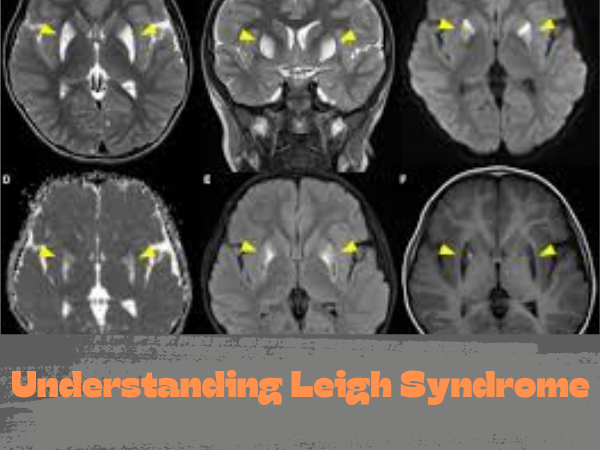 Understanding Leigh Syndrome