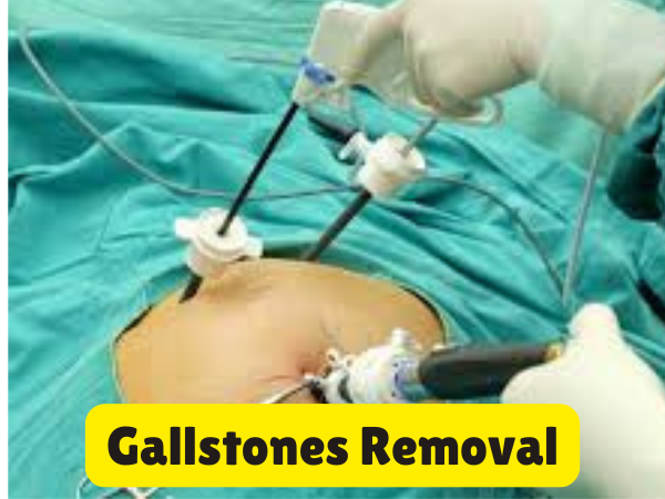 Gallstones Removal
