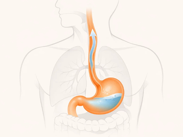 Medical illustration of acid reflux showing stomach acid moving into the esophagus causing GERD